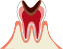 大きな虫歯
