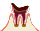 虫歯で大きく崩壊した歯
